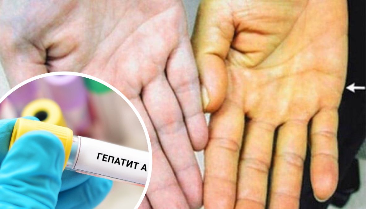 Гепатит А у Калуші: подробиці