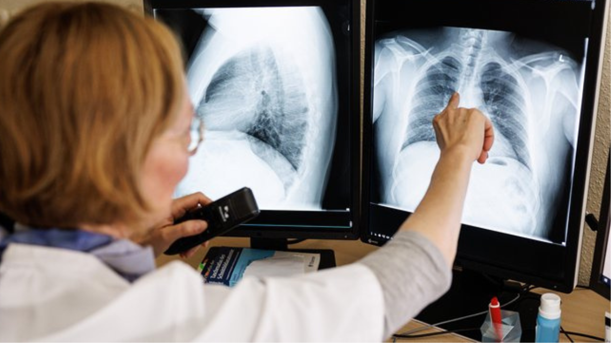 На Долинщині виявили 20 нових випадків туберкульозу серед людей