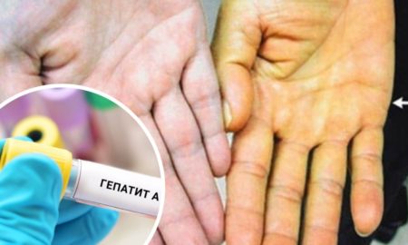 На Прикарпатті 90 випадків гепатиту А — в одному селі. Хворіють і діти, і дорослі