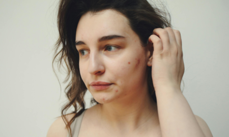 Вакцина, яка назавжди позбавить від прищів: коли вони з'явиться і чи стане обов'язковою?