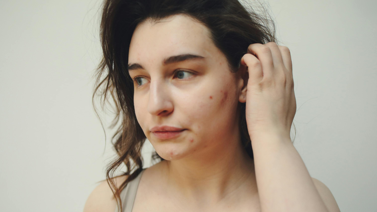 Вакцина, яка назавжди позбавить від прищів: коли вони з'явиться і чи стане обов'язковою?