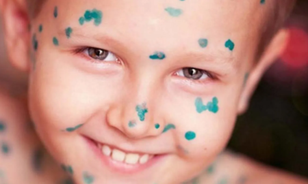 діти хворіють вітрянкою