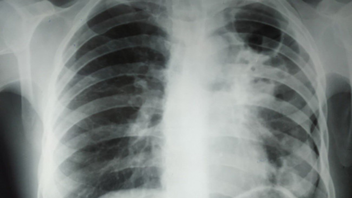 легені,туберкульоз